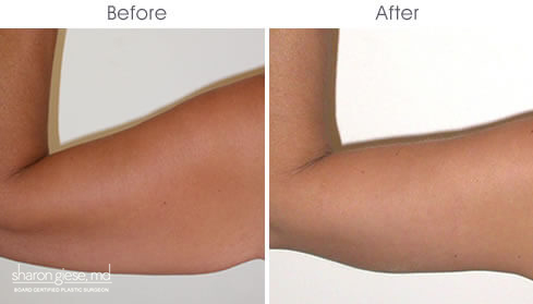 armlift surgery before after